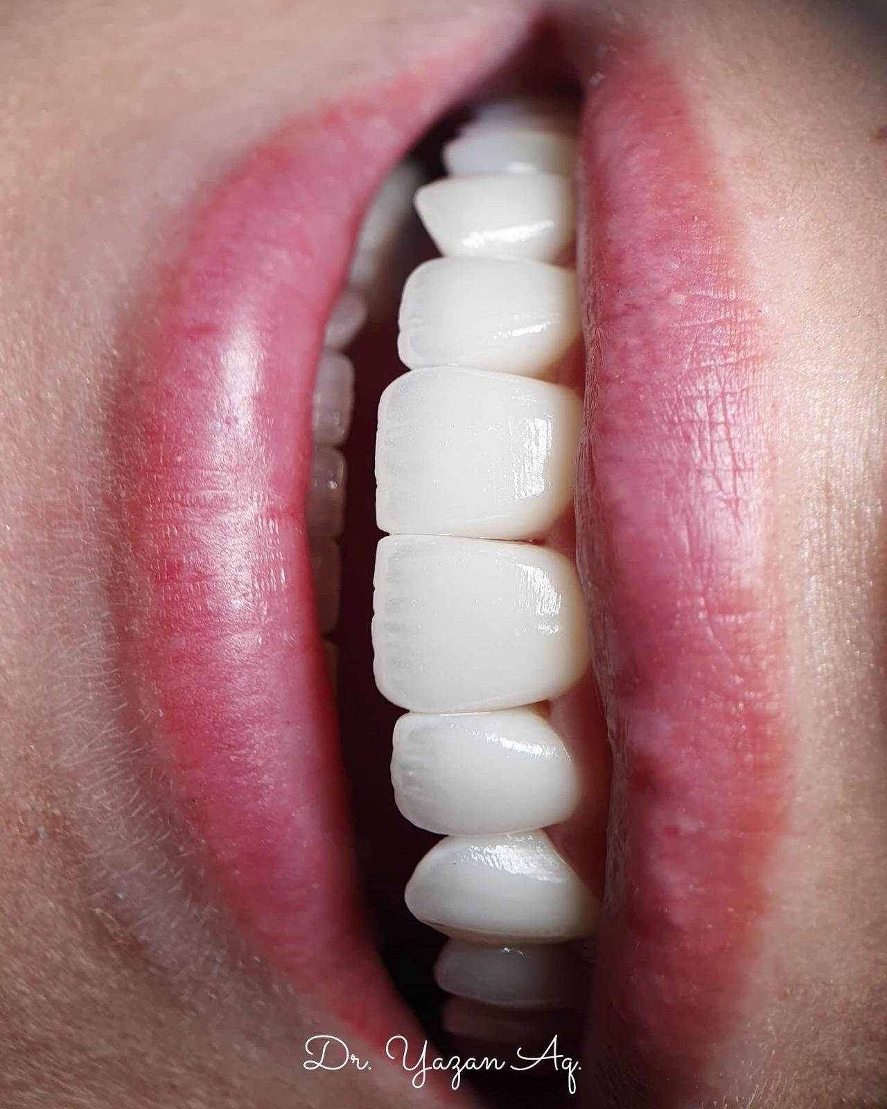 Smile detail by Dr. Yazan Aq.