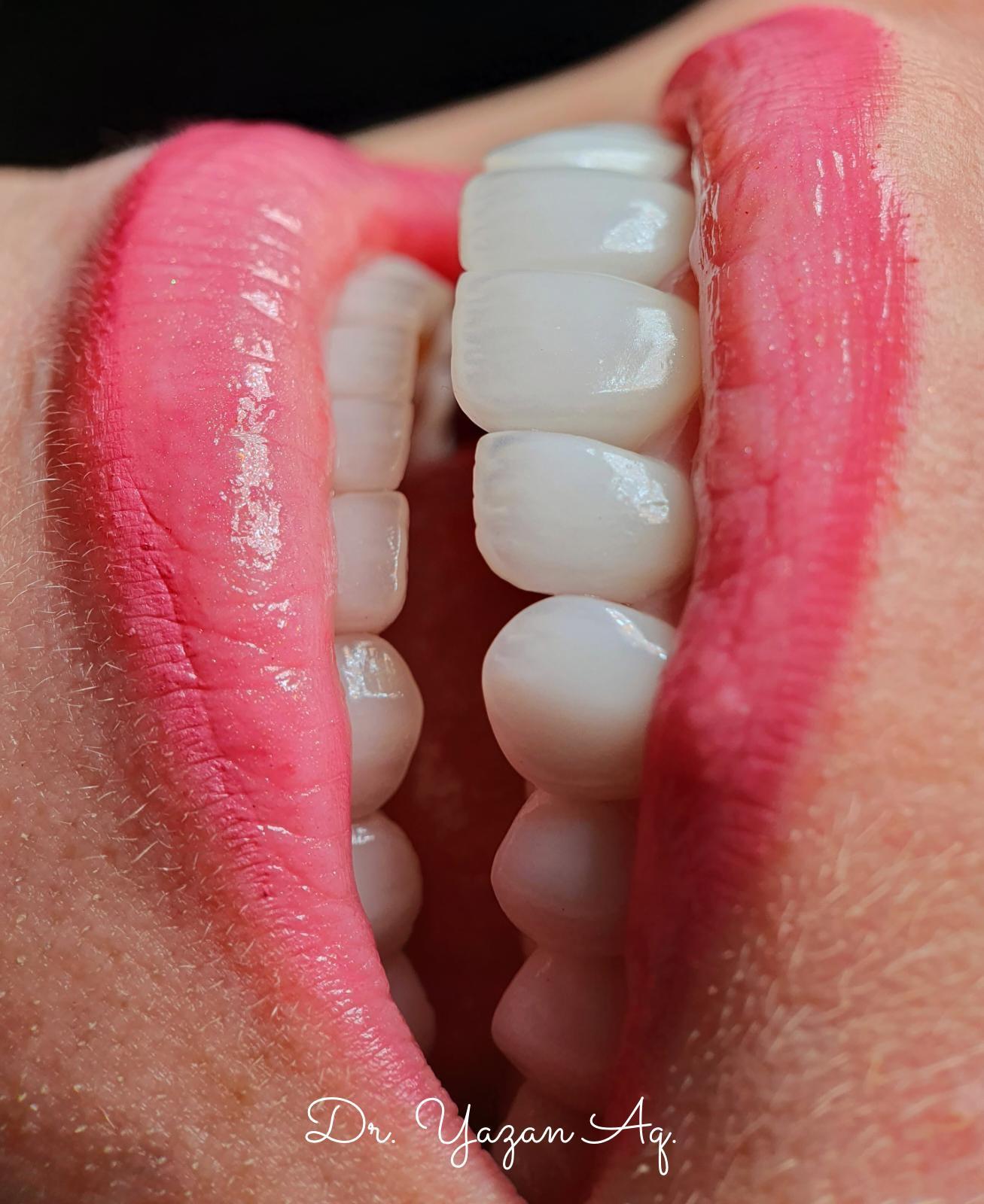 Rezultat estetic dentar realizat de Dr. Yazan Aq.