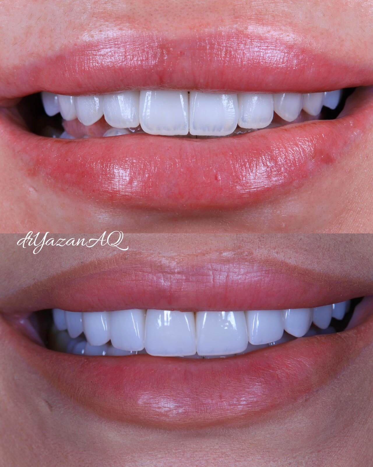 Transformare de zâmbet realizată de Dr. Yazan Aq.