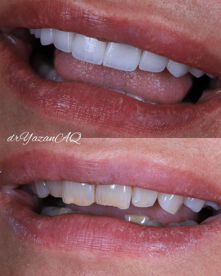 Caz Before & After realizat de Dr. Yazan Aq.