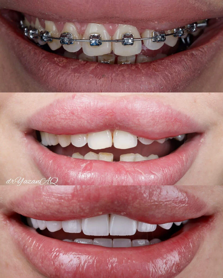 Caz Before & After realizat de Dr. Yazan Aq.