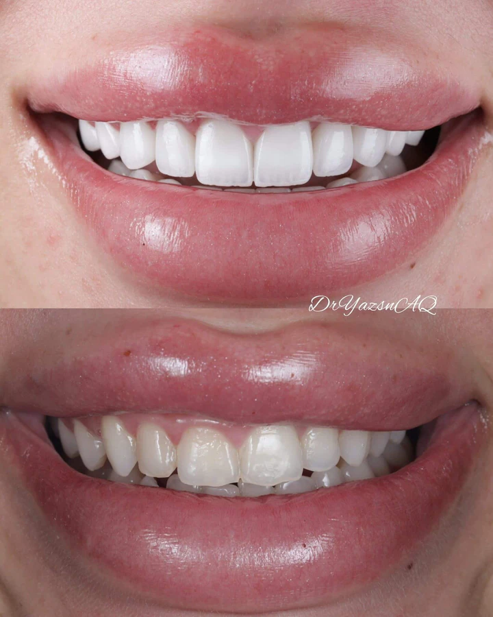 Caz Before & After realizat de Dr. Yazan Aq.