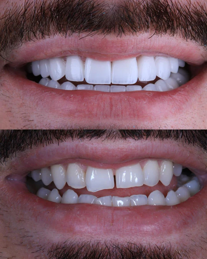 Caz Before & After realizat de Dr. Yazan Aq.