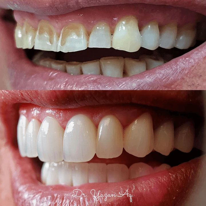 Caz Before & After realizat de Dr. Yazan Aq.