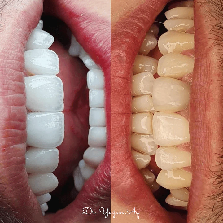 Caz Before & After realizat de Dr. Yazan Aq.