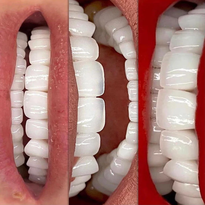 Caz Before & After realizat de Dr. Yazan Aq.