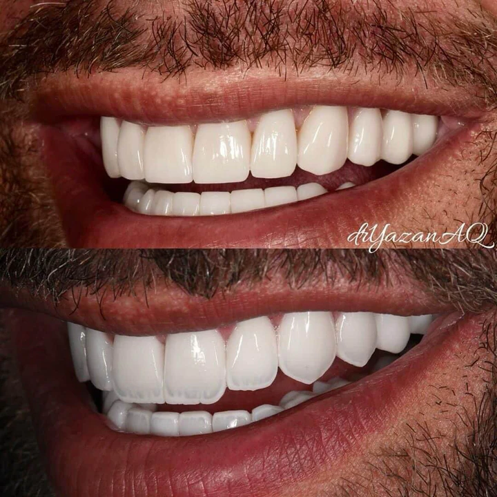 Caz Before & After realizat de Dr. Yazan Aq.