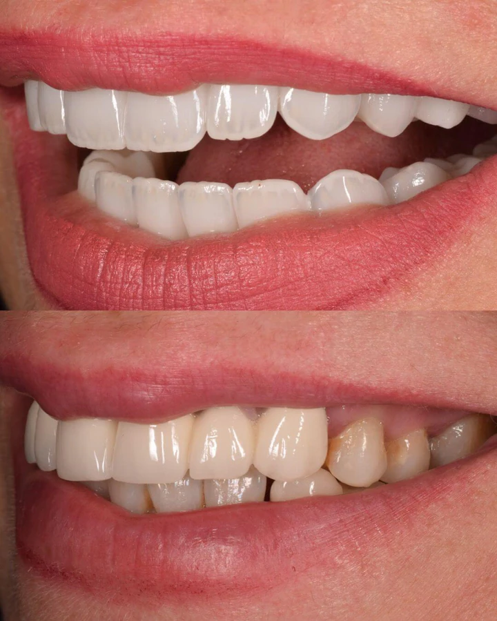 Caz Before & After realizat de Dr. Yazan Aq.