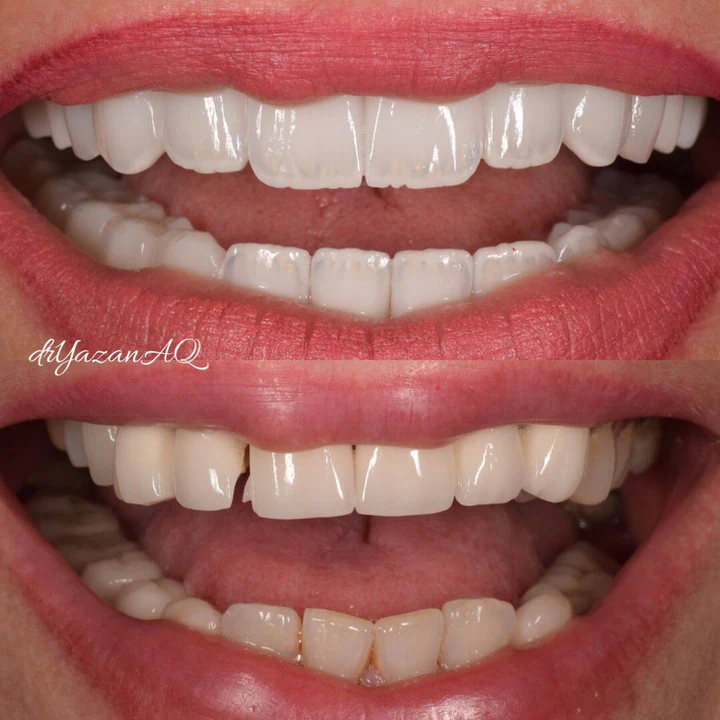 Caz Before & After realizat de Dr. Yazan Aq.