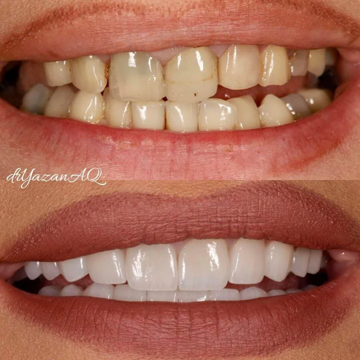 Caz Before & After realizat de Dr. Yazan Aq.