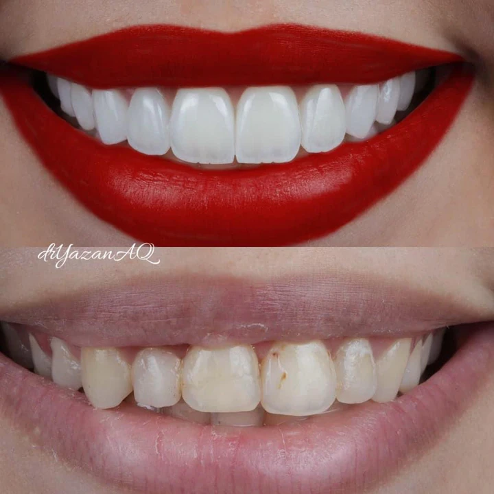 Caz Before & After realizat de Dr. Yazan Aq.