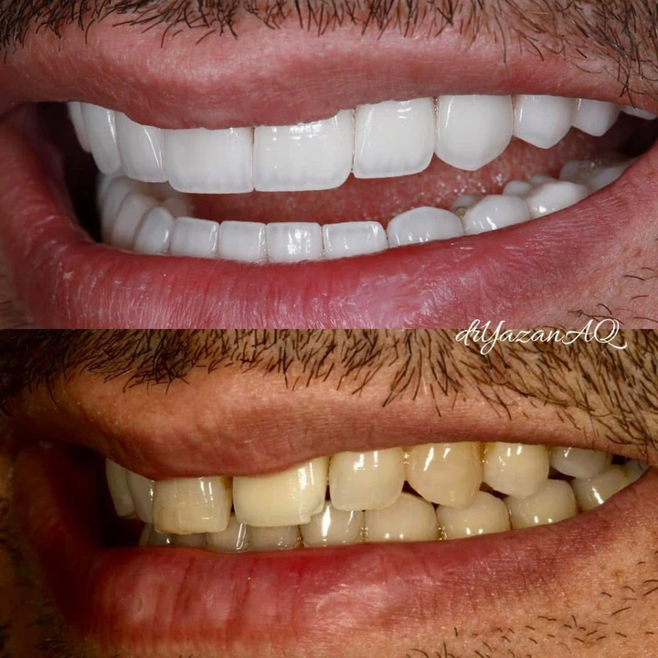 Caz Before & After realizat de Dr. Yazan Aq.