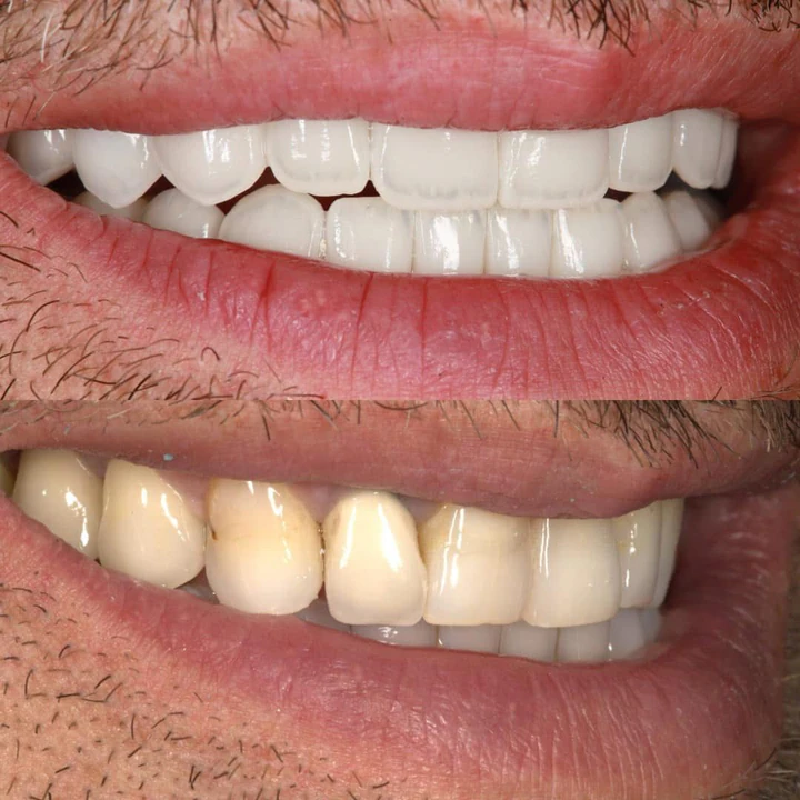 Caz Before & After realizat de Dr. Yazan Aq.