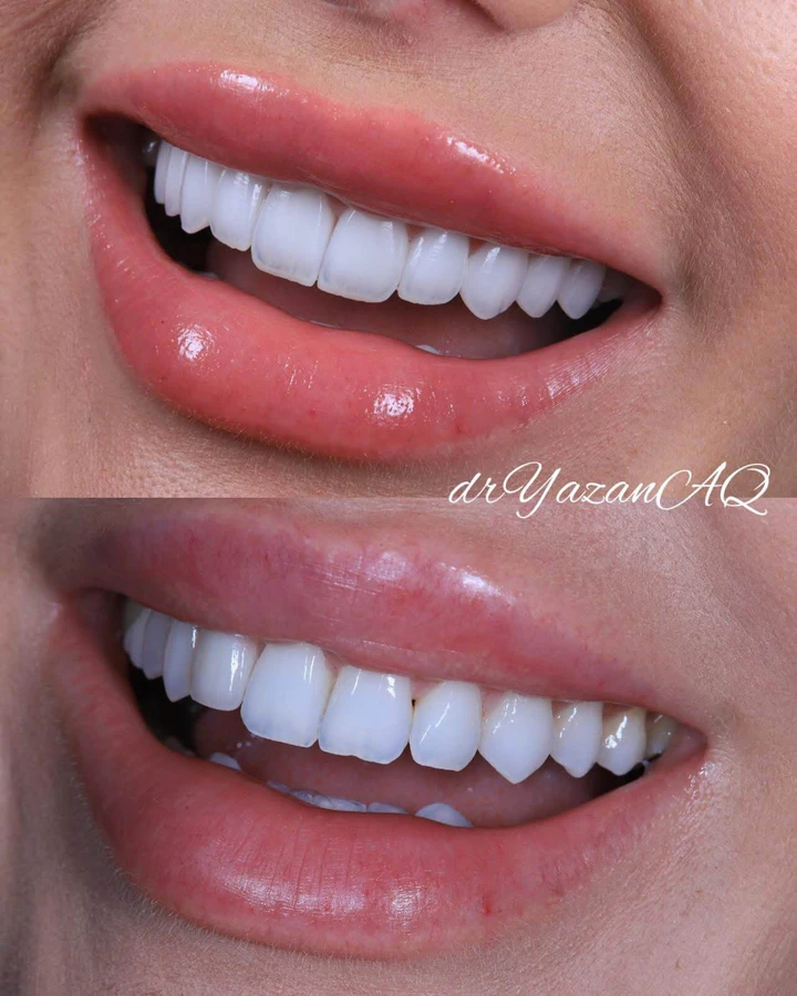 Caz Before & After realizat de Dr. Yazan Aq.