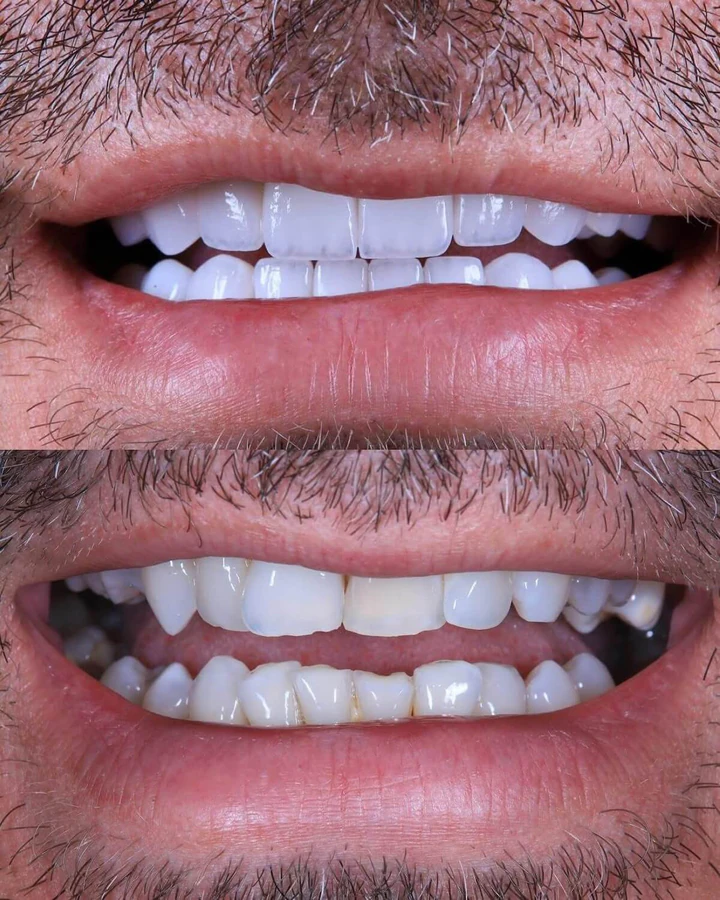 Caz Before & After realizat de Dr. Yazan Aq.