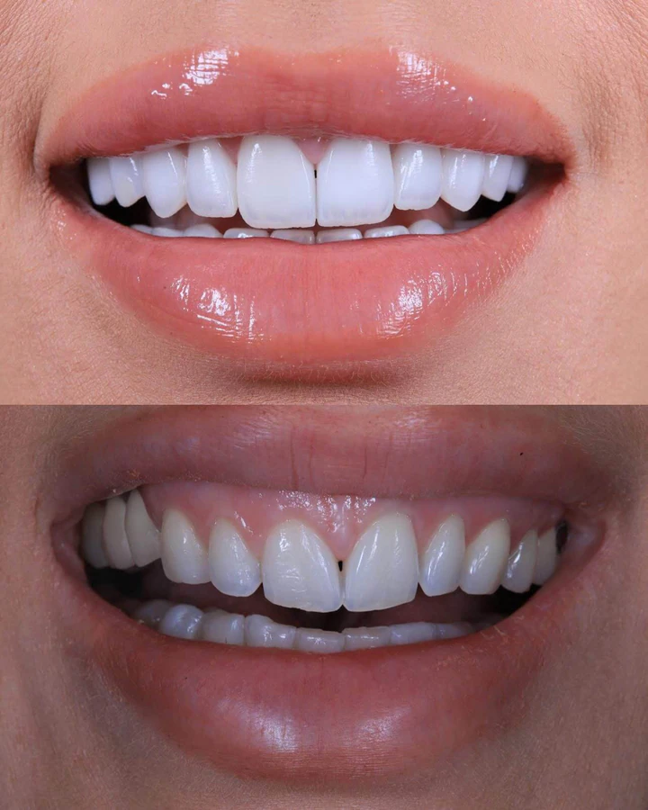 Caz Before & After realizat de Dr. Yazan Aq.