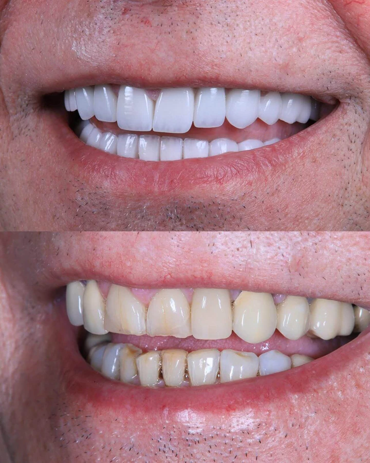 Caz Before & After realizat de Dr. Yazan Aq.