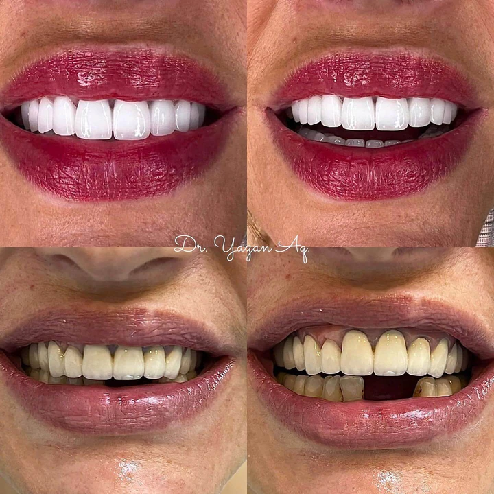 Caz Before & After realizat de Dr. Yazan Aq.
