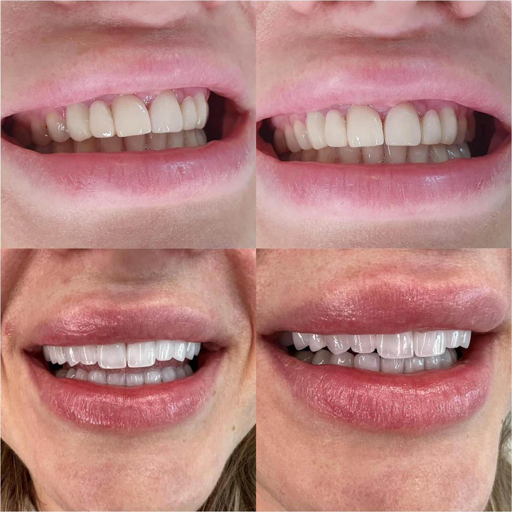Caz Before & After realizat de Dr. Yazan Aq.