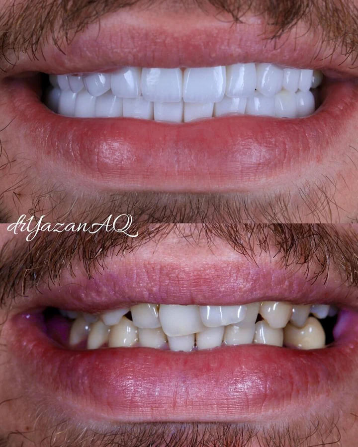 Caz Before & After realizat de Dr. Yazan Aq.