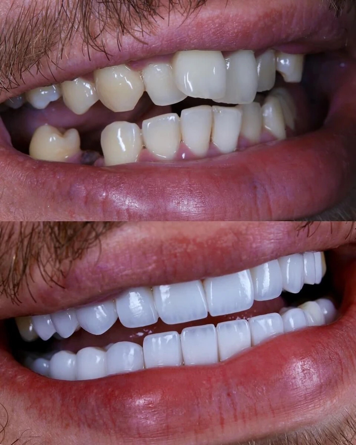 Caz Before & After realizat de Dr. Yazan Aq.