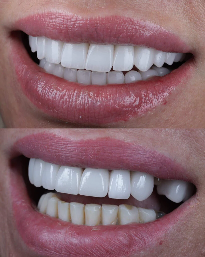 Caz Before & After realizat de Dr. Yazan Aq.