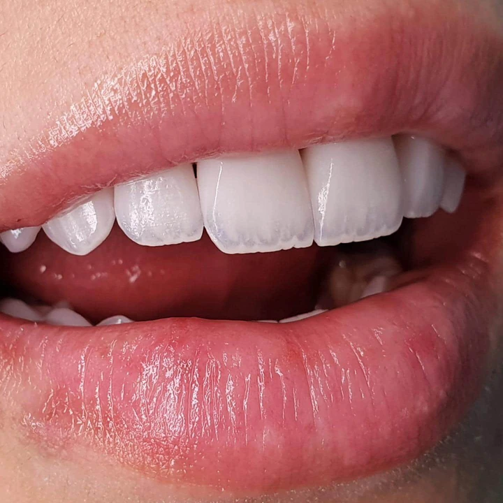 Caz Before & After realizat de Dr. Yazan Aq.