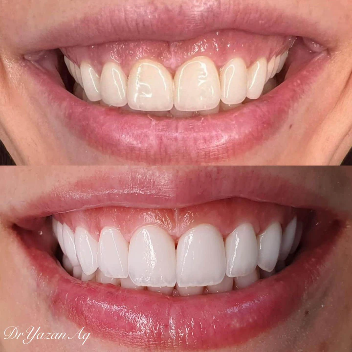 Caz Before & After realizat de Dr. Yazan Aq.