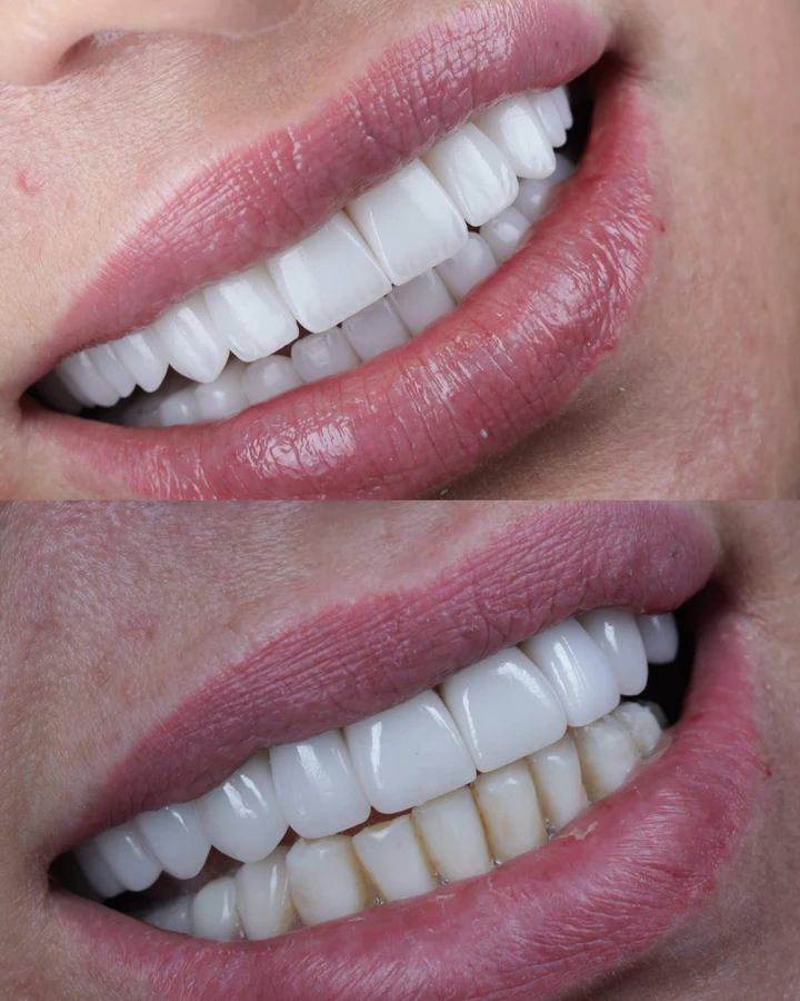 Caz Before & After realizat de Dr. Yazan Aq.