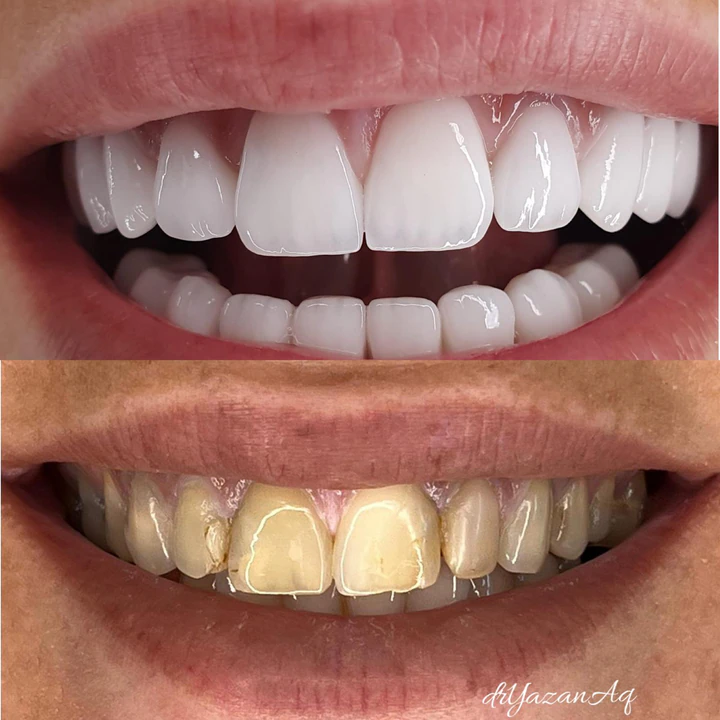 Caz Before & After realizat de Dr. Yazan Aq.