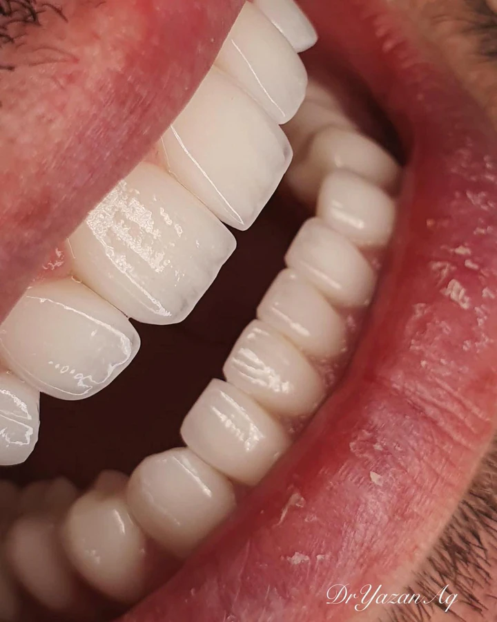 Caz Before & After realizat de Dr. Yazan Aq.