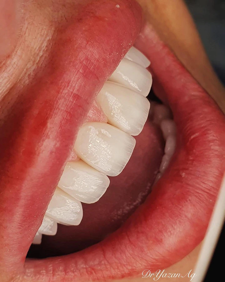 Caz Before & After realizat de Dr. Yazan Aq.