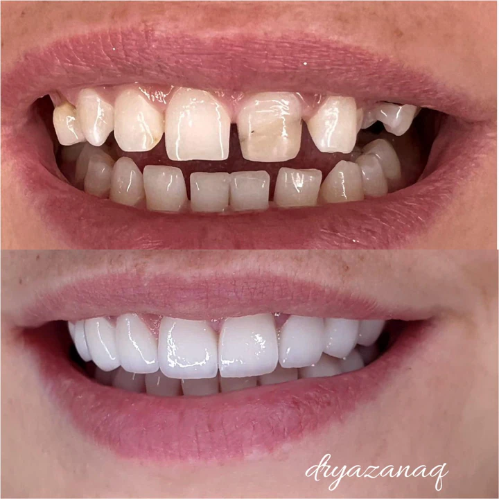 Caz Before & After realizat de Dr. Yazan Aq.