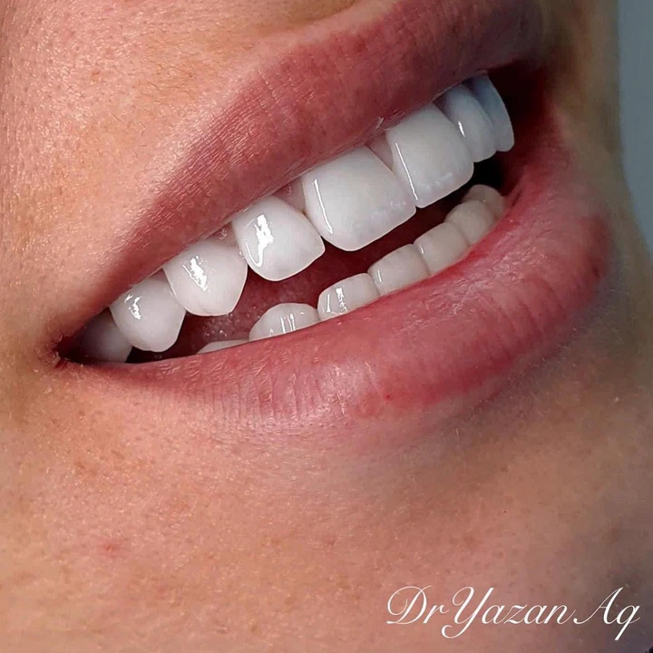 Caz Before & After realizat de Dr. Yazan Aq.
