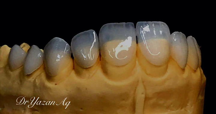 Caz Before & After realizat de Dr. Yazan Aq.