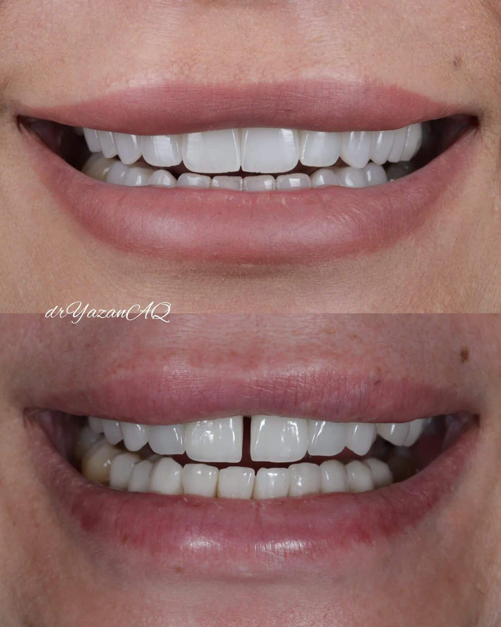 Caz Before & After realizat de Dr. Yazan Aq.