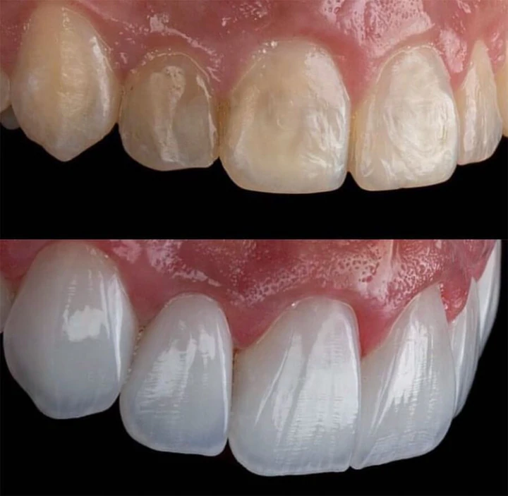 Caz Before & After realizat de Dr. Yazan Aq.