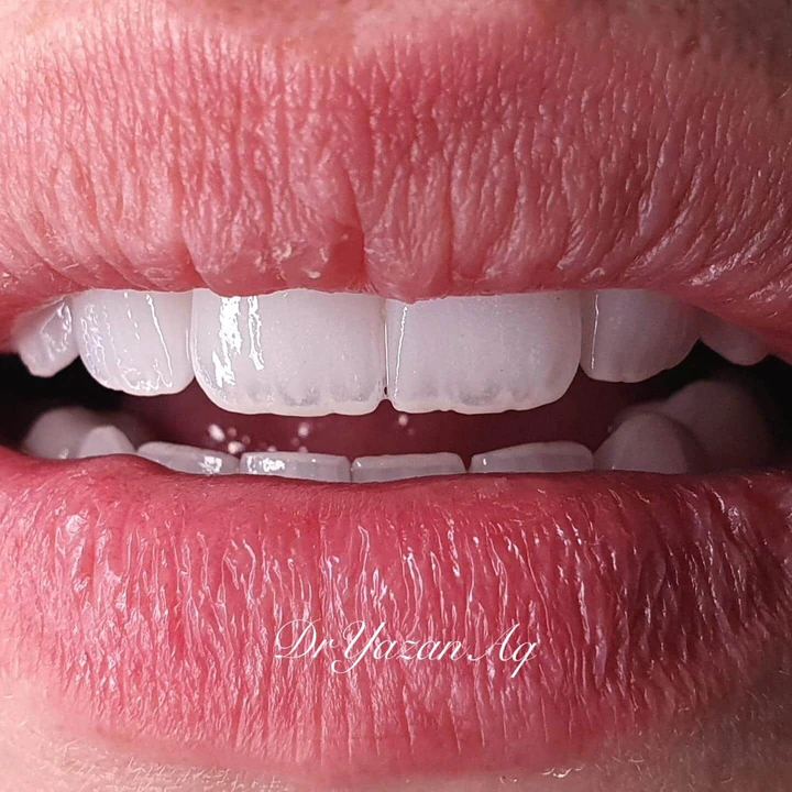 Caz Before & After realizat de Dr. Yazan Aq.