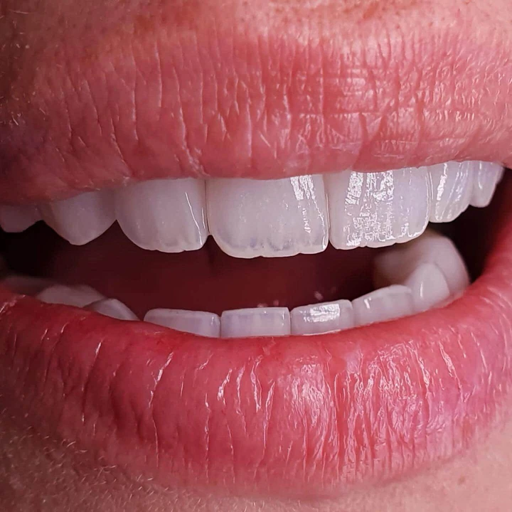 Caz Before & After realizat de Dr. Yazan Aq.