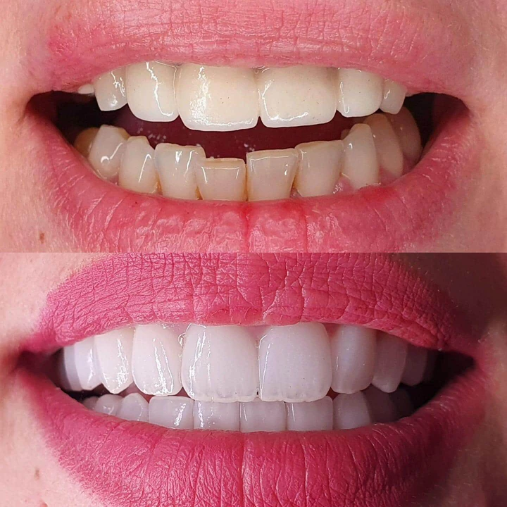 Caz Before & After realizat de Dr. Yazan Aq.