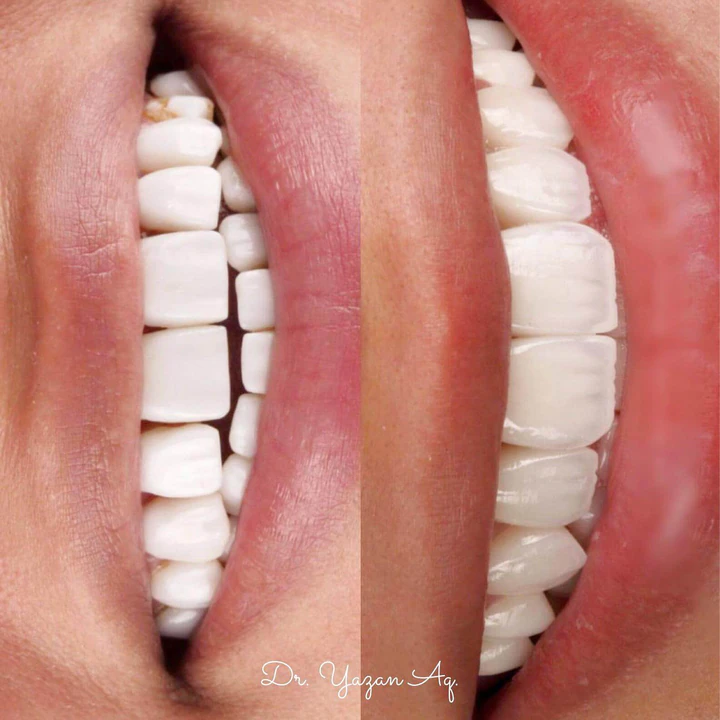 Caz Before & After realizat de Dr. Yazan Aq.