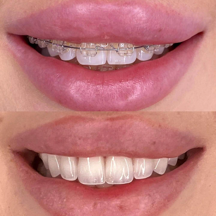 Caz Before & After realizat de Dr. Yazan Aq.