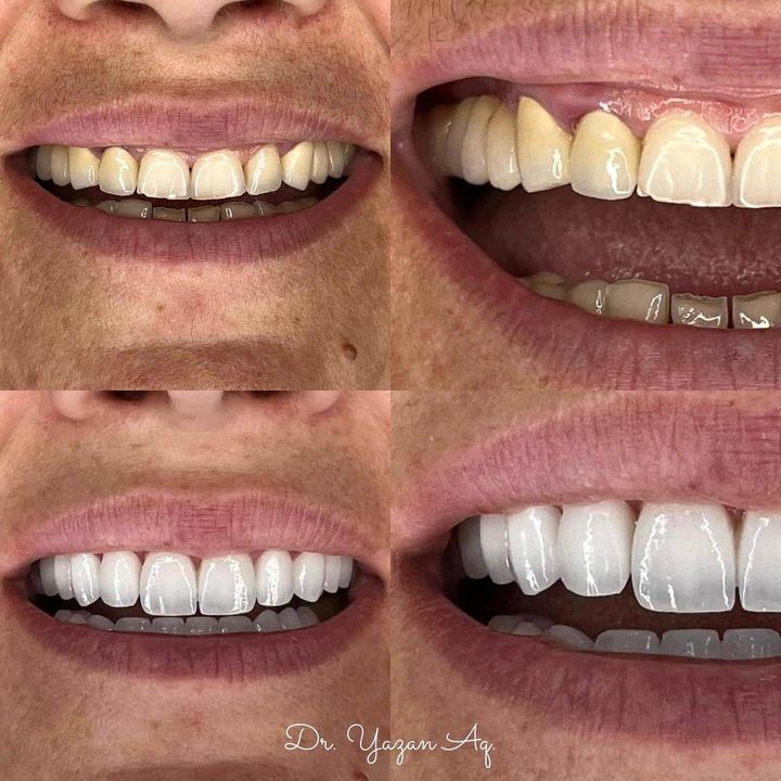 Caz Before & After realizat de Dr. Yazan Aq.