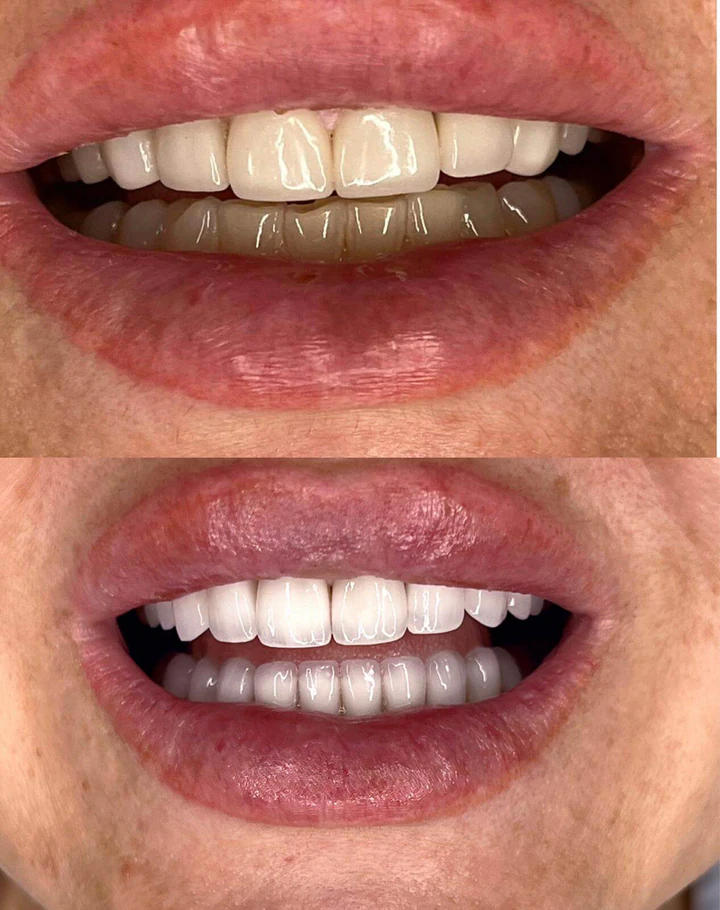 Caz Before & After realizat de Dr. Yazan Aq.