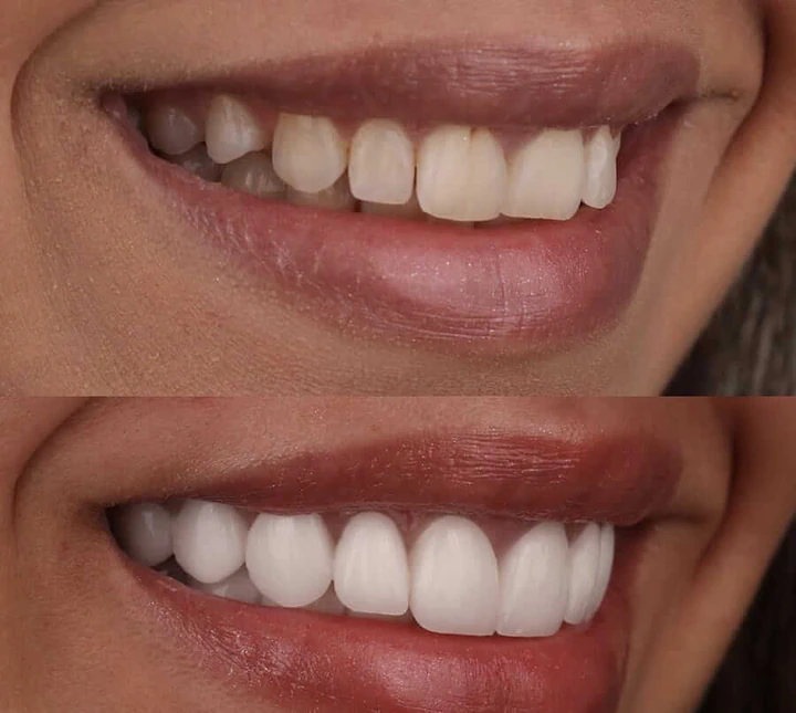 Caz Before & After realizat de Dr. Yazan Aq.