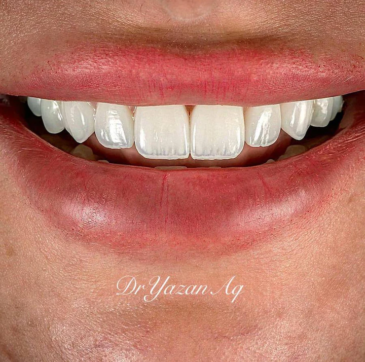 Caz Before & After realizat de Dr. Yazan Aq.