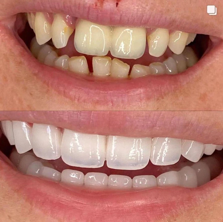 Caz Before & After realizat de Dr. Yazan Aq.