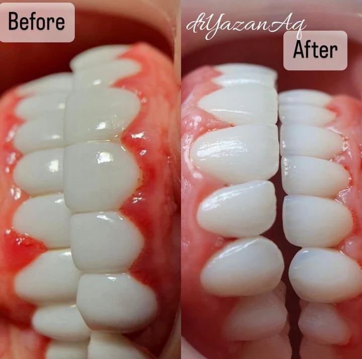 Caz Before & After realizat de Dr. Yazan Aq.