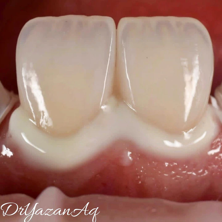 Caz Before & After realizat de Dr. Yazan Aq.