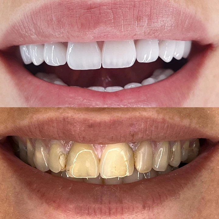 Caz Before & After realizat de Dr. Yazan Aq.